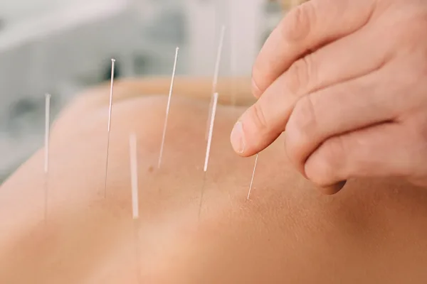 acupuncture treatment